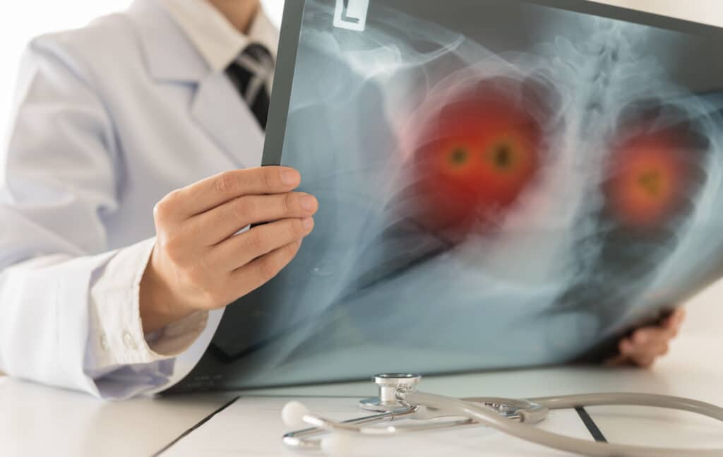 Arrêter de fumer après un diagnostic de cancer reste bénéfique